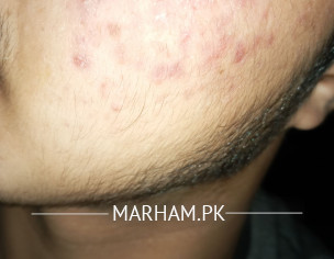 Acne, Acne Marks, Pimples