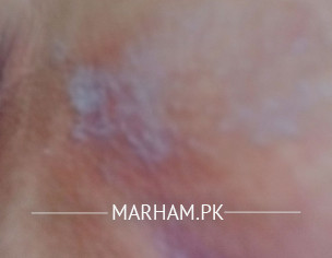 Skin Issue