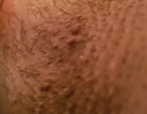 Tiny Bump On Penile Shaft