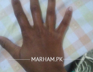 Skin Problm
