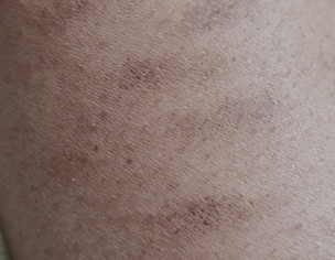 Skin Hyperpigmentation