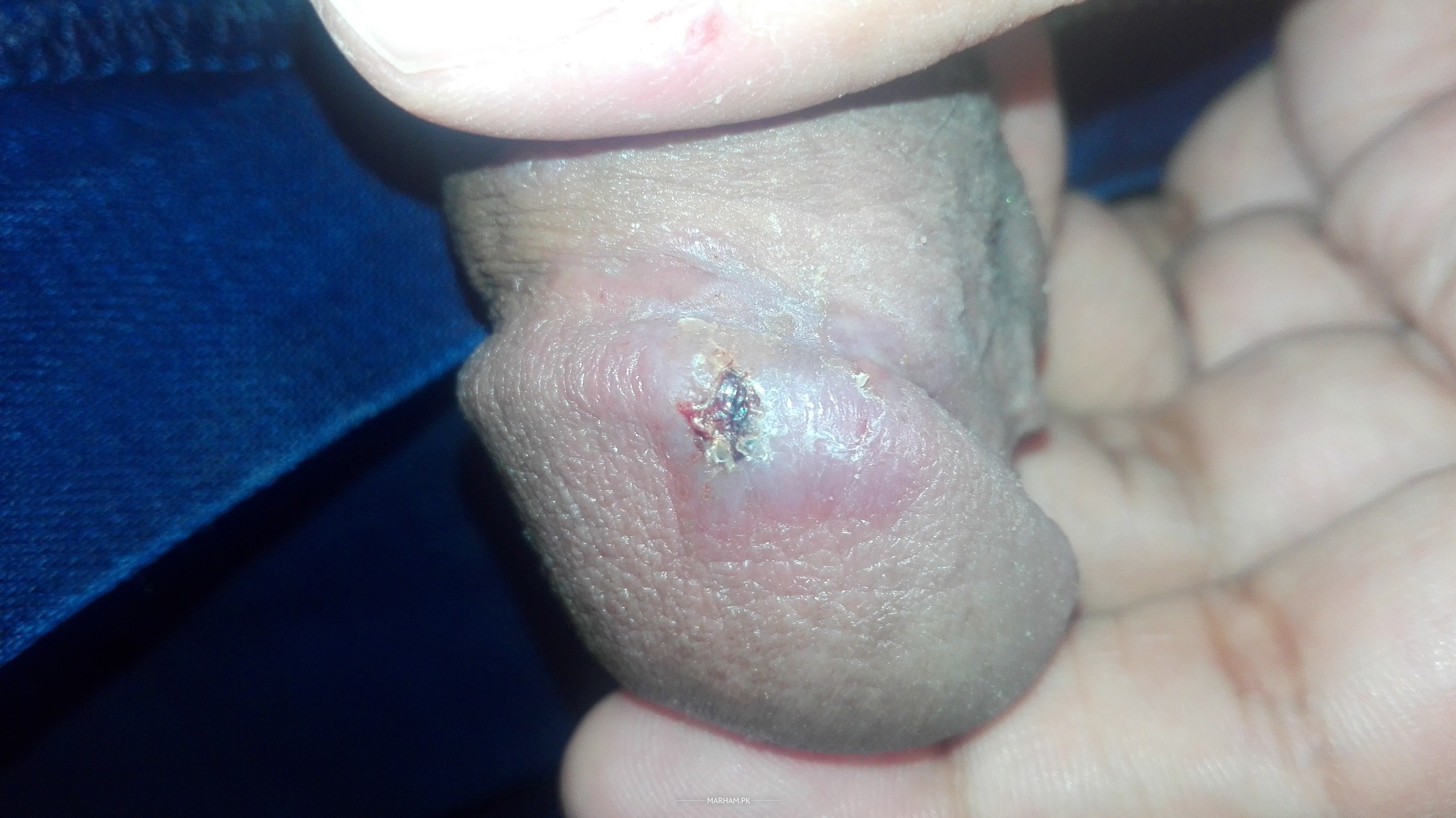 Painful ulcers on the penis