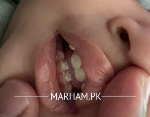 White Spots On Teeth