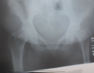 Hip Fracture 