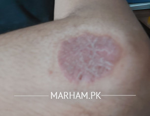 Psoriasis