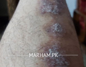 Psoriasis