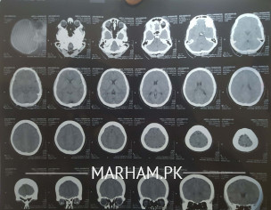 CT Scan Plane Brain