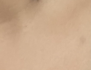 Permanent Scar Mark On Neck