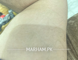 Heat Release From Arm