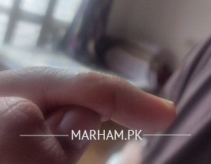 ہاتھوں پر خارش