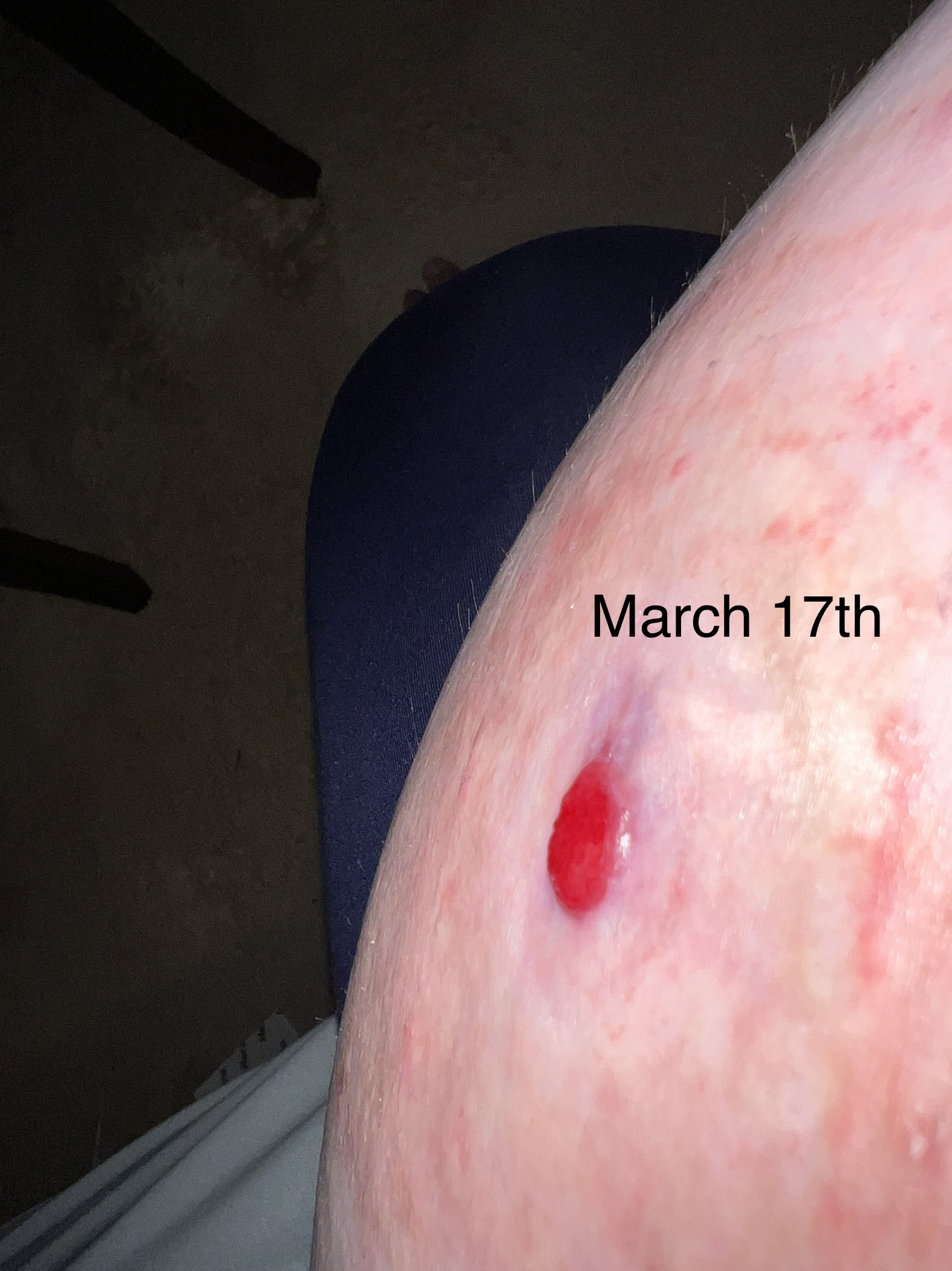 Weeping Wounds: A Dermatologist'S Perspective - aewej9a