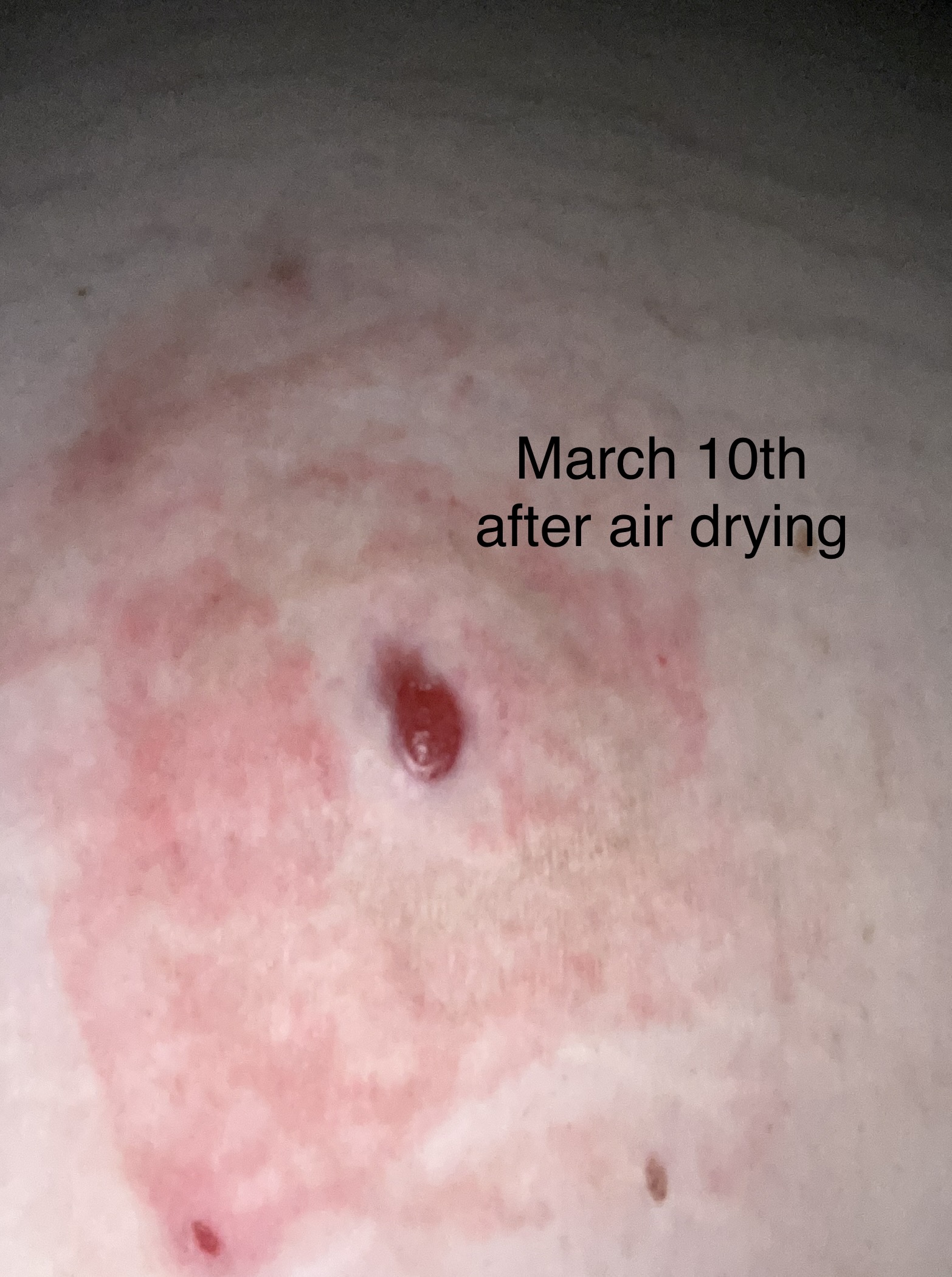 Weeping Wounds: A Dermatologist'S Perspective - m4bhraa