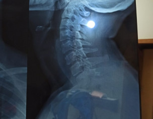 Neck Pain And Headache