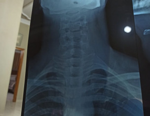 Neck Pain And Headache