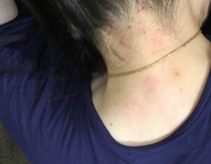 Head Itching/rash