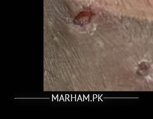 Genital Wart Or HPV