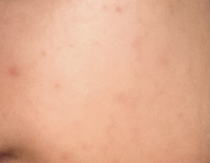 Light Mild Red Spots Acne