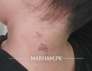 Maybe I Have Psoriasis