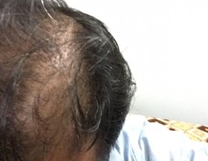 Hair Fall 