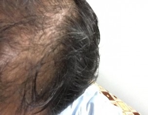 Hair Fall 