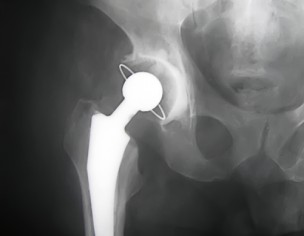Hip  Pain After Surgery