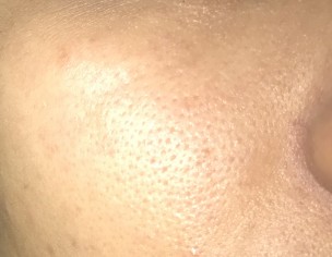 Large Open Pores 