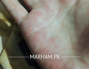 Allergy On Hands