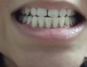 Upper Teeth Start Shifting And Developing Gap