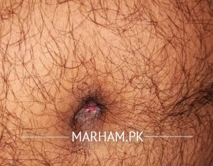 Bleeding From Belly Button