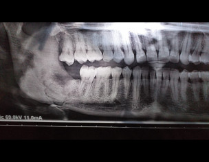 Wisdom Tooth Surgery