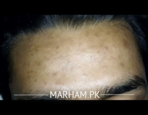 Forehead Pimples Marks