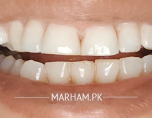 Misaligned Teeth/veneers