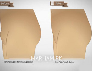 Reduce Supra-pubic Fat