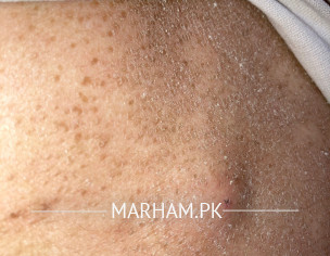 Pimple Inside Skin