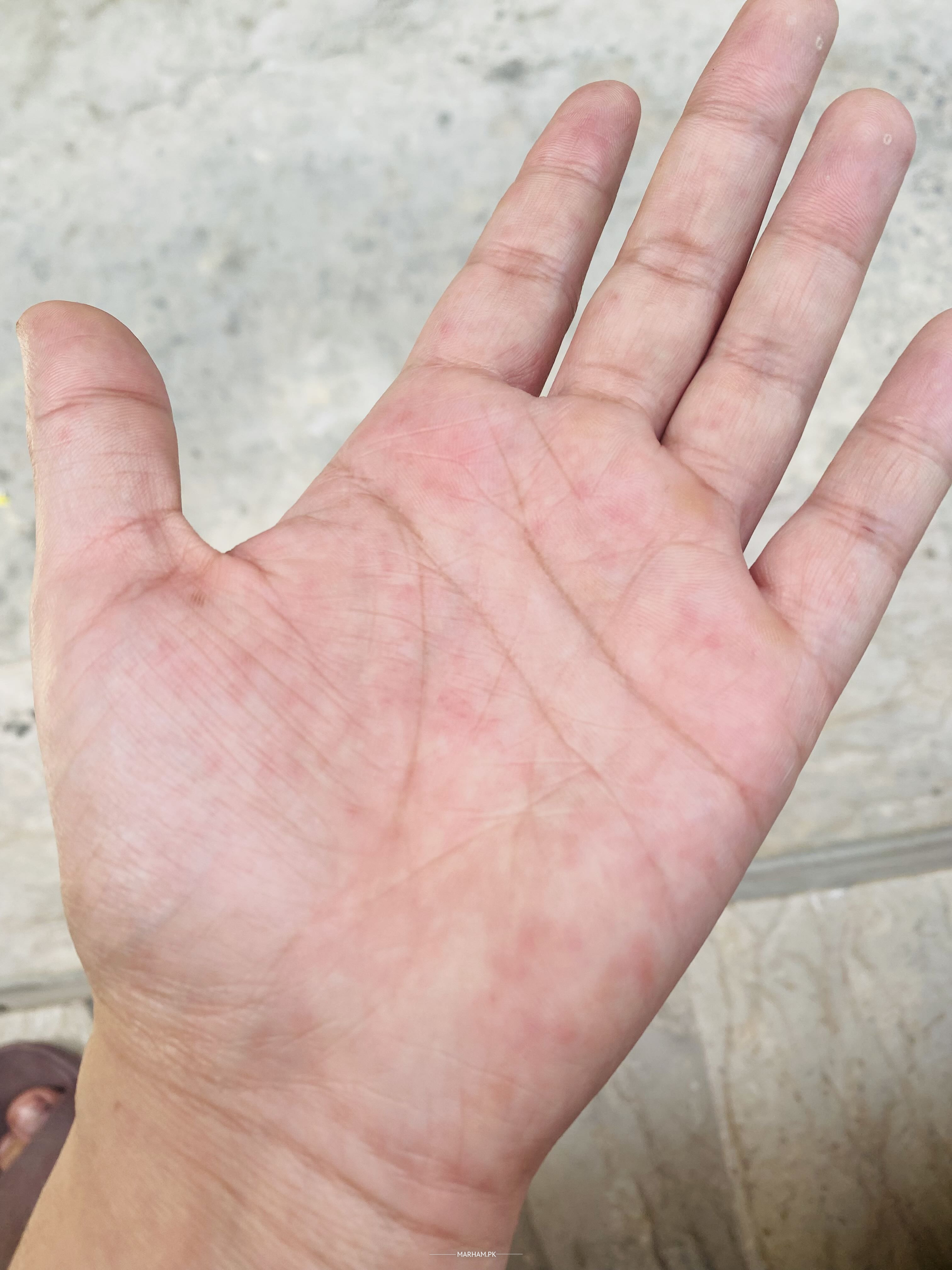 Itchy Bumps On Hands After Sun Exposure