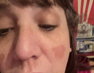 Sores Raw Lumps Inside Cheeks