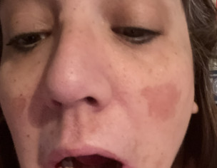 Sores Raw Lumps Inside Cheeks