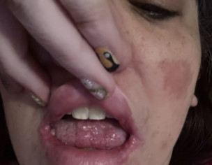 Sores Raw Lumps Inside Cheeks