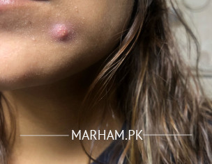 Face- Big Hard Pimple 
