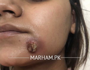 Face- Big Hard Pimple 