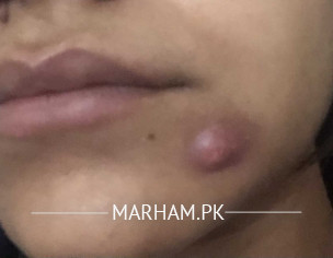 Face- Big Hard Pimple 