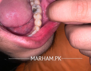 Pain In Tooth