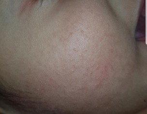 Cheeks Redness