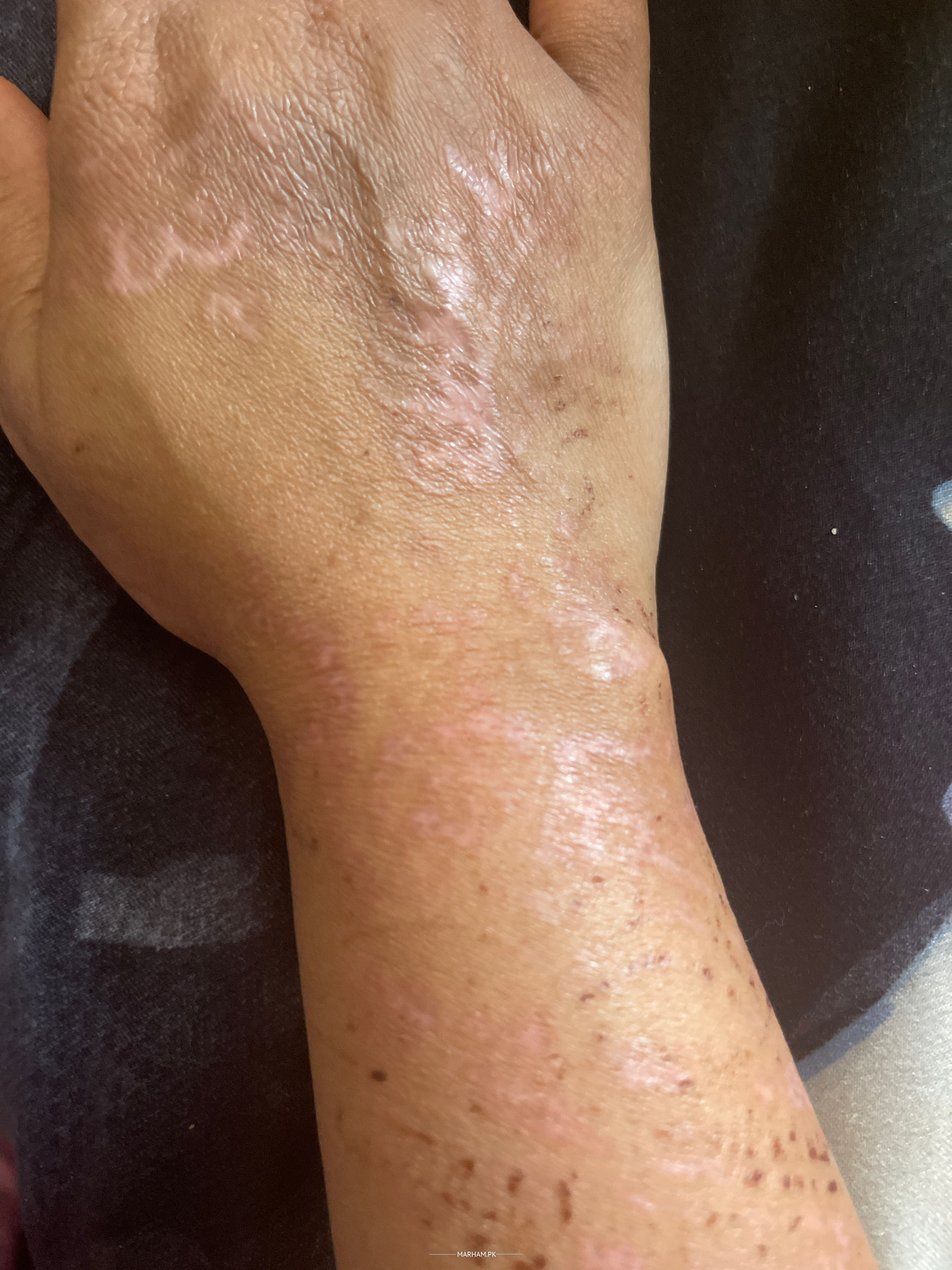 Update 137+ allergy due to mehndi super hot POPPY