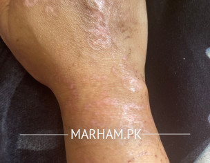 Skin Condition With Mehndi 