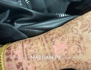 Skin Condition With Mehndi 