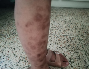 Excoriation/skin Picking Scars /hyperpigmentation