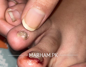 Broken Nail Dermatologist