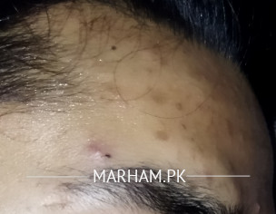 Pimples Marks (dark Spots)