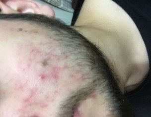 Acne With Redness 